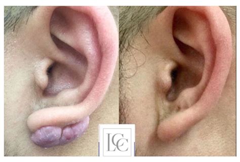 Keloid On-Ear: Causes and Treatments | Keloid Scar Treatment Clinic ...