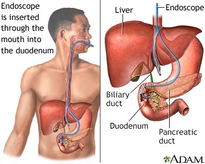 ERCP Information | Mount Sinai - New York