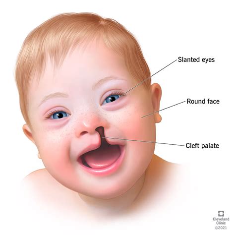 Trisomy: Types of Trisomy Disorders | Flipboard