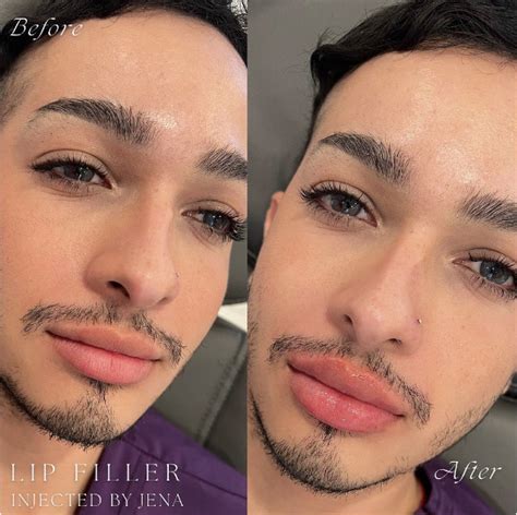 Lip Flip Botox Before And After Photos - Infoupdate.org