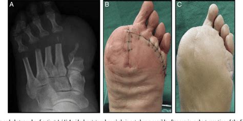 Figure 1 from Plantar rotational flap technique for panmetatarsal head ...