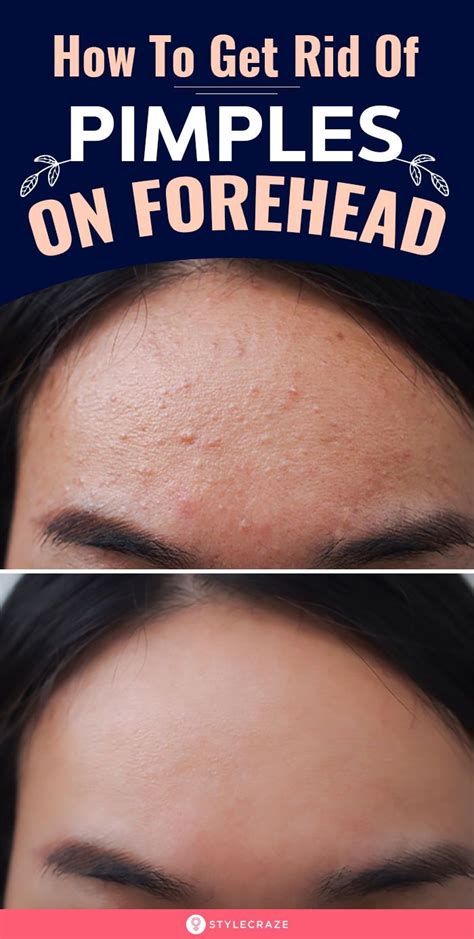 How To Get Rid Of Pimples On Forehead | Pimples on forehead, Clear skin ...