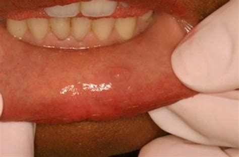 Mucous Cyst Inside Lip | Sitelip.org