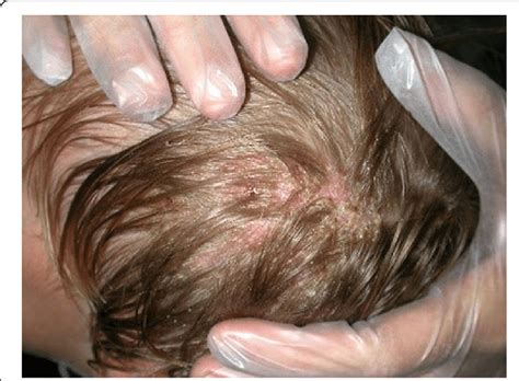 Neonatal Scalp Lesions