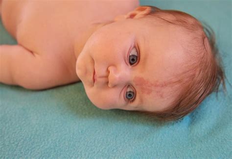 Port Wine Stains in Babies : Condition, Causes, Signs & Treatment