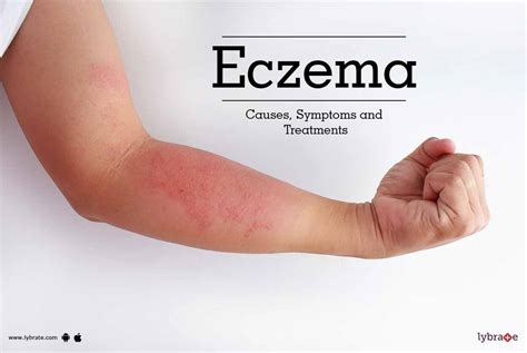 Eczema - Causes, Symptoms and Treatments - By Dr. Himanshu Singhal ...