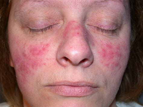 Acne Rosacea - Causes, Symptoms, Treatment, Pictures, Diet | Diseases ...