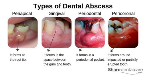 Dental-Abscess-Types-Periapical-Gingival-Periodontal-and-Pericoronal ...