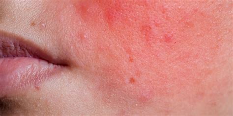 Most Common Causes of Localized Facial Rash | HealthNews