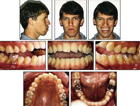 Treatment and retreatment of a patient with a severe anterior open bite ...