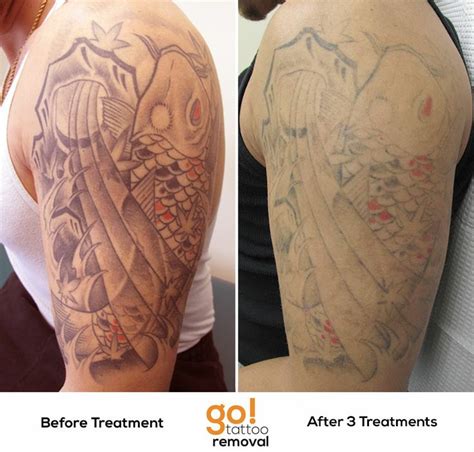 dermabrasion tattoo removal before and after - Maranda Bolden