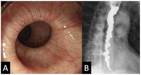 Diffuse Esophageal Spasm: Corkscrew Esophagus - The American Journal of ...