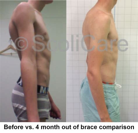 Case – Kyphosis Bracing