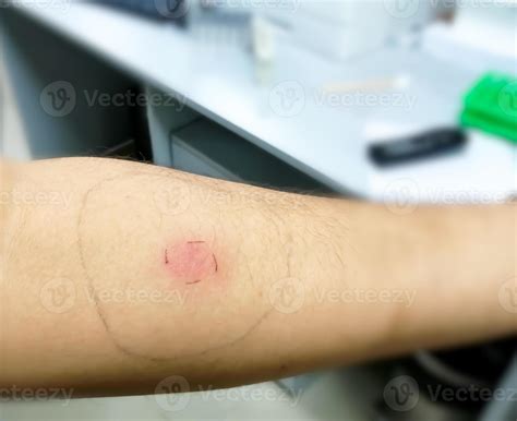 Mantoux vaccination, Closeup view photography of patient arm with red ...