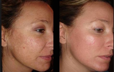 Post-inflammatory Hyperpigmentation is a skin condition in which the ...