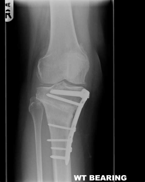 Osteotomy | Buckinghamshire knee surgery