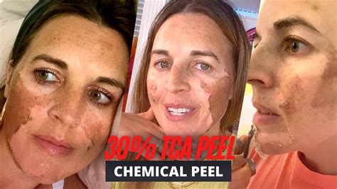 BEFORE AND AFTER 30% TCA Chemical Peel: Procedure, Peeling, Herpes ...