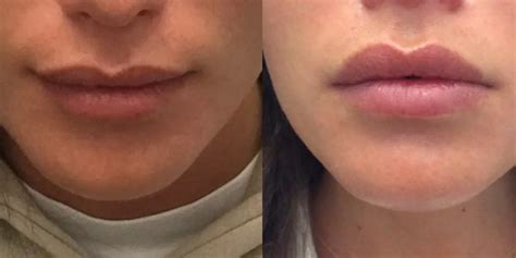 Botox Lip Flip Before and After: What is a Lip Flip and Who Needs It ...