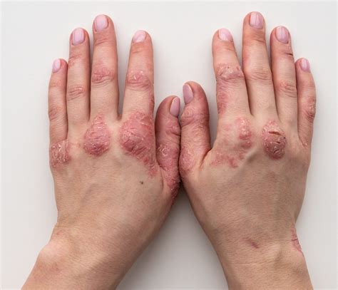 Psoriasis Triggers and Treatments | Durban Skin Doctor