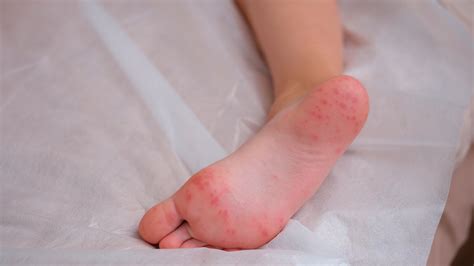 Foot Dyshidrotic Eczema: Symptoms And More, 50% OFF