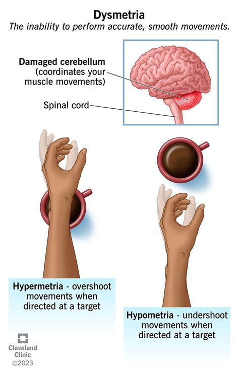 Dysmetria: What It Is, Types, Causes, Symptoms & Treatment