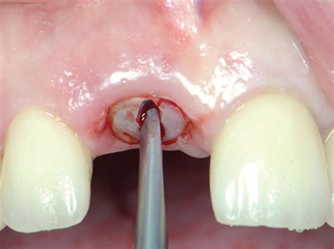 How to Extract Teeth as Atraumatically as Possible: Root Sectioning ...