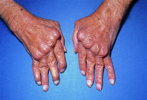 Hands With Rheumatoid Arthritis by Science Photo Library