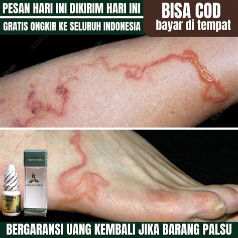 Jual Obat Cacing Larva, Cutaneous Larva Migrans, Cacing Tambang Di ...