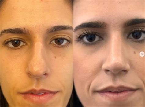 Rinoplastia de nariz bulbosa - Icifacial