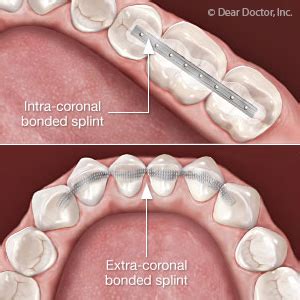 Have a Loose Tooth? You'll Need This Two-Phase Treatment to Save It