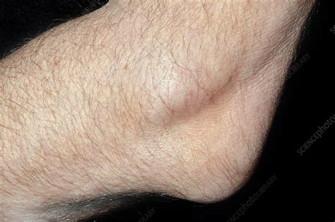 Bursitis of the elbow - Stock Image - C028/4456 - Science Photo Library