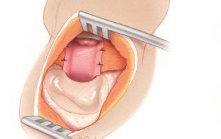 Postauricular Meatoplasty – Oto Surgery Atlas