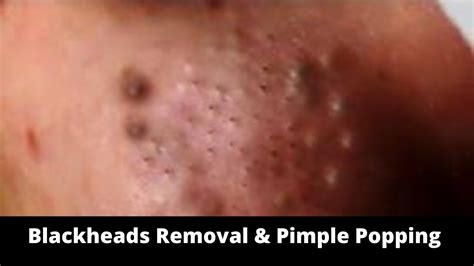 Pimple Popping Videos 2024 Blackheads Popping - Sadie Collette