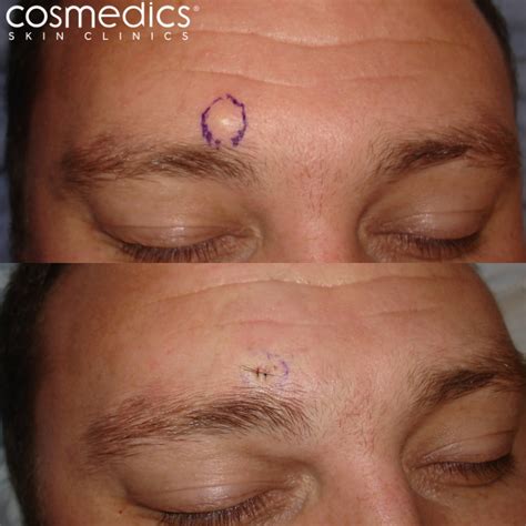 Cyst Removal London Surgical Treatment | Cosmedics Skin Clinics