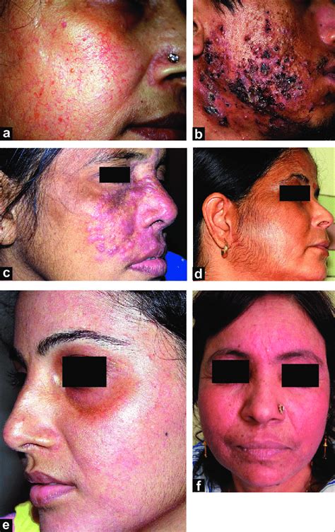 Adverse effects of topical corticosteroids on the face. (a) Marked ...