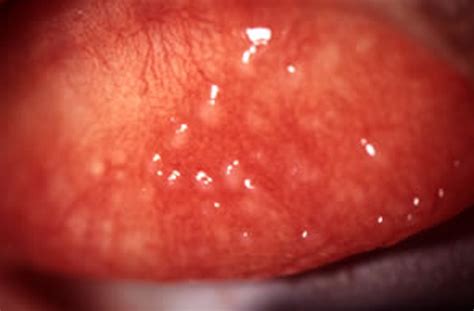 Enlarged Papillae - Pictures, Symptoms, Causes, Treatment