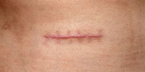 Scar from stitches How to prevent it : cauze, soluții, produse La Roche ...