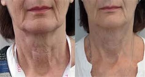 Before and After Profhilo Treatment | Wrinkle Smoothing Ireland | Navan ...