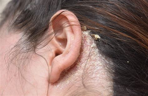 Ear Psoriasis | Psoriasis on the Ears