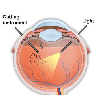 Pars Plana Vitrectomy in Los Angeles, CA | The Retina Partners