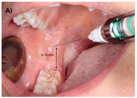 Inferior Alveolar Nerve Block Landmarks