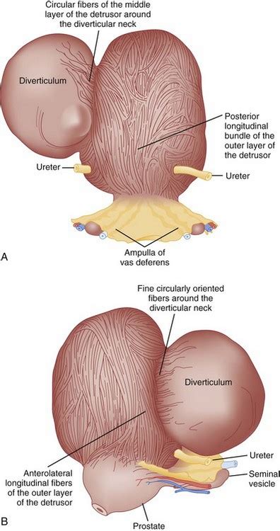 Bladder and Female Urethral Diverticula | Abdominal Key