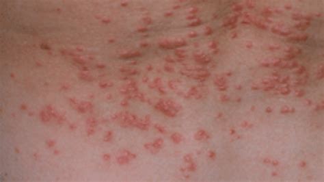 What Is Scabies? Symptoms, Causes, Diagnosis, Treatment, And Prevention ...