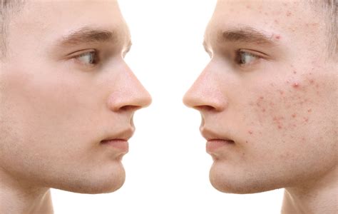 Removing Acne and Restoring Your Confidence | CDAM