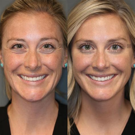 Dysport, Jeuveau & Xeomin Spokane | Cosmetic Injections Liberty Lake