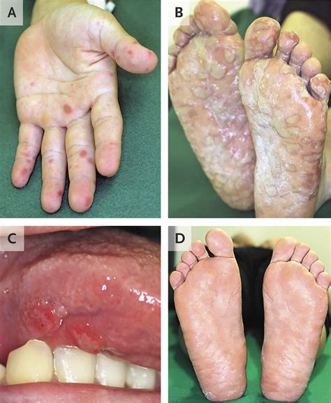 Hand foot and mouth disease, causes, signs, symptoms, diagnosis ...