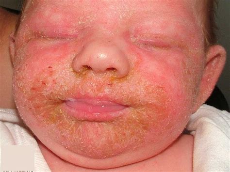 Eczema And Atopic Dermatitis Rashes Causes Symptoms