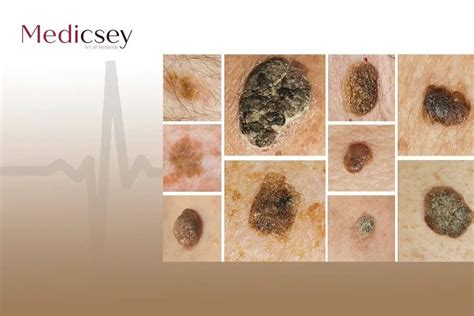 Causes and treatment of seborrheic keratosis