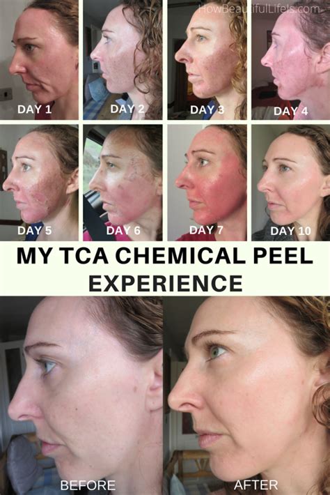 My TCA Chemical Peel Experience | How Beautiful Life Is