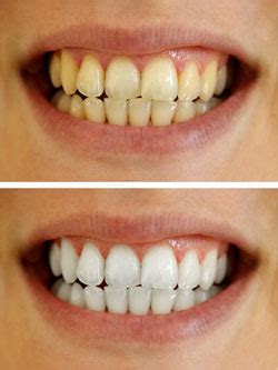 Best At-Home Teeth Whitening Methods | Randwick Dental Clinic